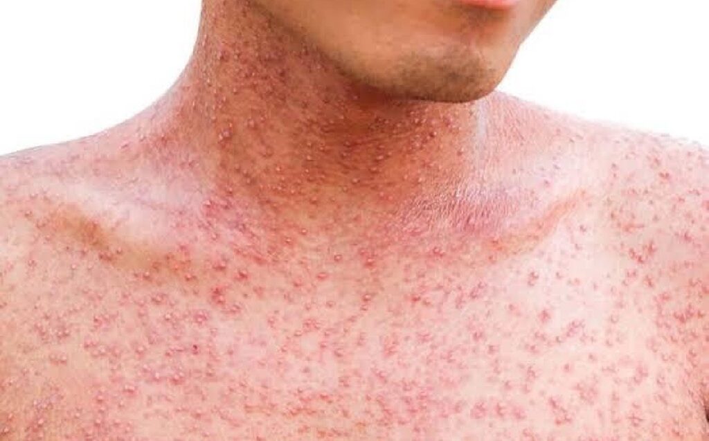 Secretaría de Salud emite comunicado sobre los brotes de Sarampión.