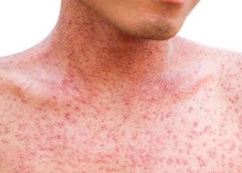 Secretaría de Salud emite comunicado sobre los brotes de Sarampión.