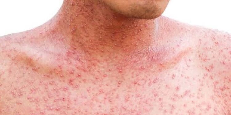 Secretaría de Salud emite comunicado sobre los brotes de Sarampión.