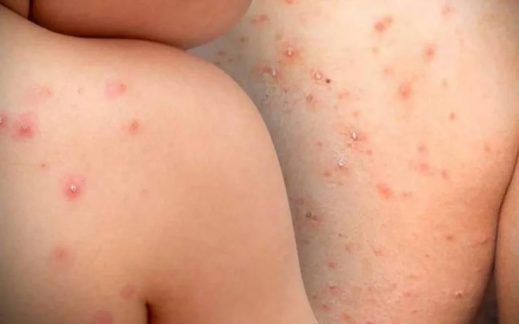 Muere bebé por sarampión en Tlaxcala