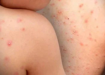 Muere bebé por sarampión en Tlaxcala