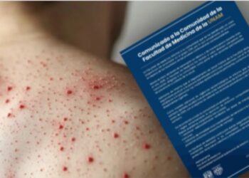 UNAM reporta un caso sospechoso de sarampión