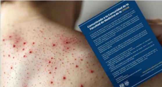 UNAM reporta un caso sospechoso de sarampión